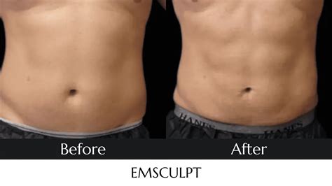 emsculpt pechange california|EMSCULPT .